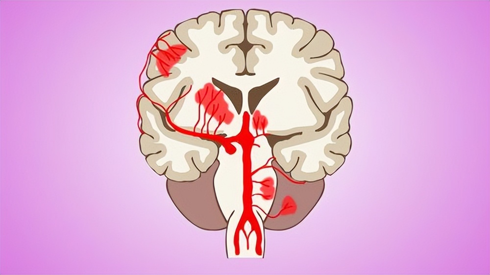 45岁男子吃饭时突发脑出血！医生坦言：他犯的3大错误，值得借鉴