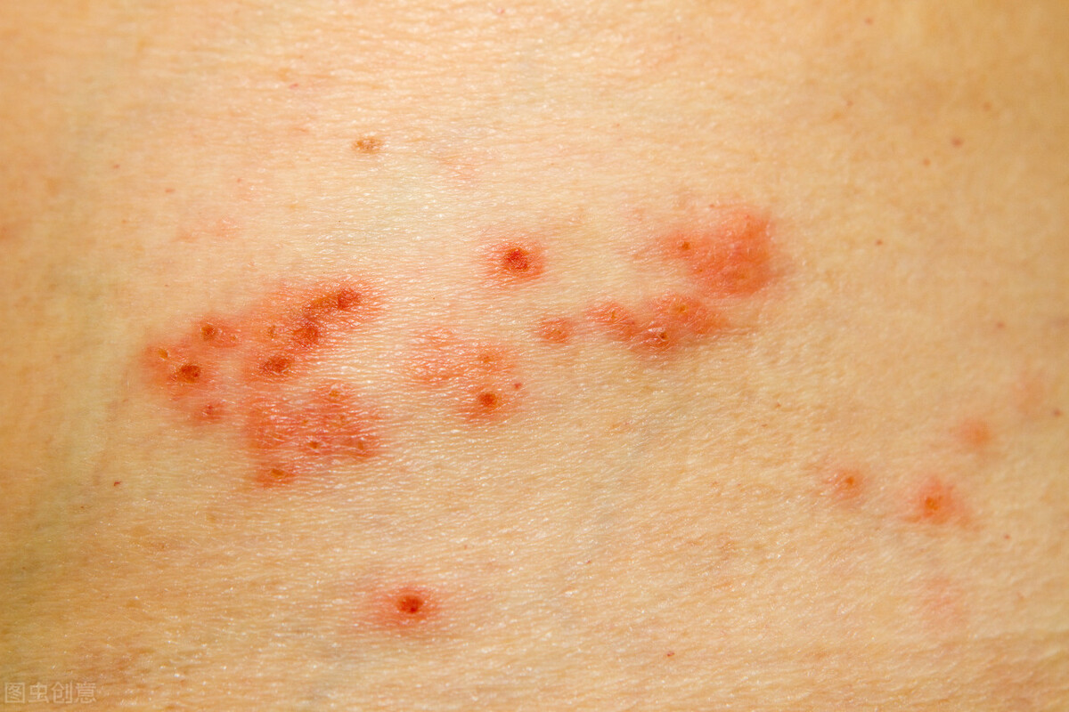 皮膚過敏症狀 紅疹|皮膚- 皮膚過敏症狀 紅疹|皮膚 - 快熱資訊 - 走進時代