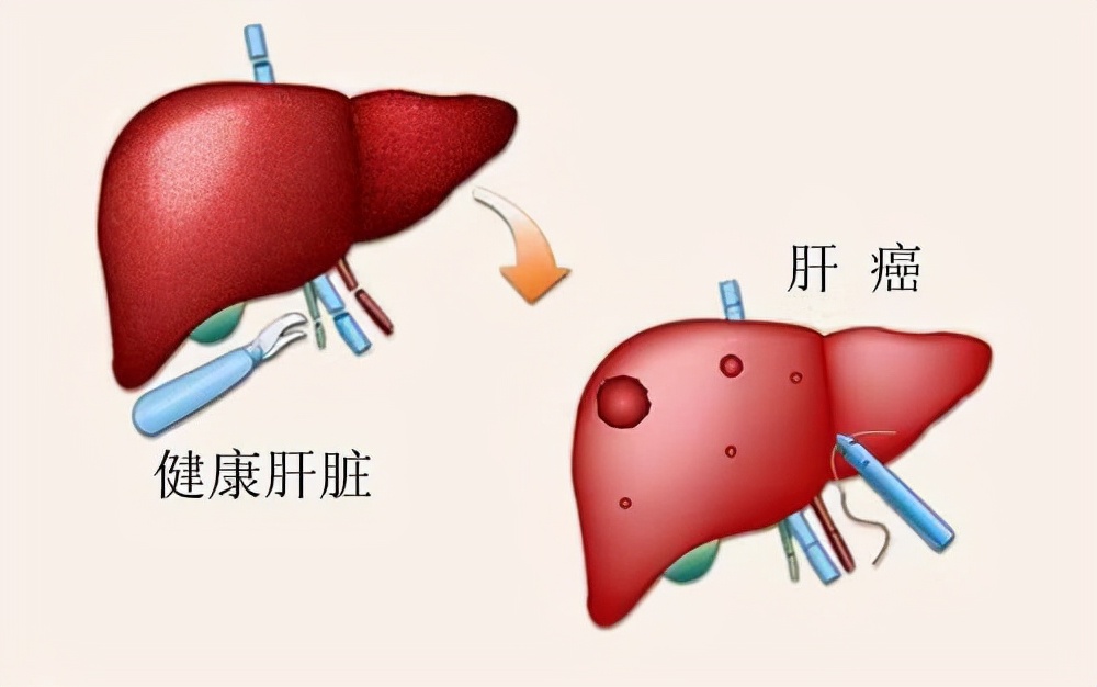女性“患癌”的6大恶习？熬夜垫底，看完榜首，或要趁早改正