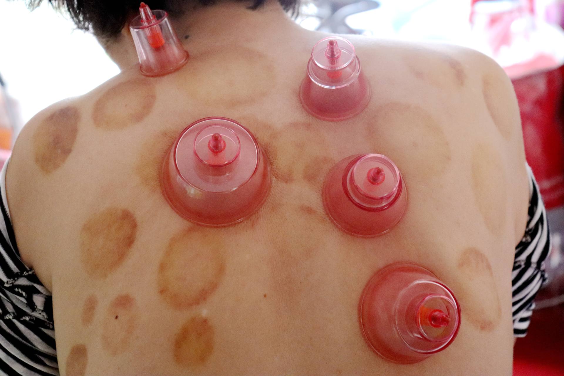 养生好帮手——左点走罐按摩器