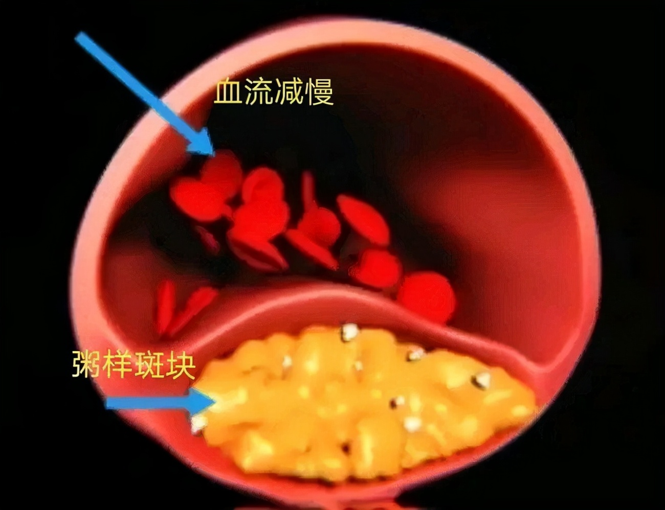 颈动脉斑块，怎么查？怎么治？别吃哪种水果？本文为您全讲清