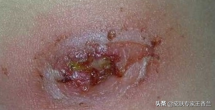 ①病因:首先,疖子并不是上火导致的,它是由细菌感染毛囊炎所导致的.