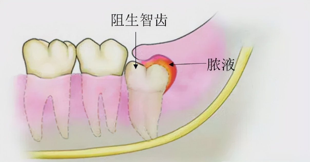 牙龈反复发炎、肿痛？3个原因作怪，警惕出现全身性并发症