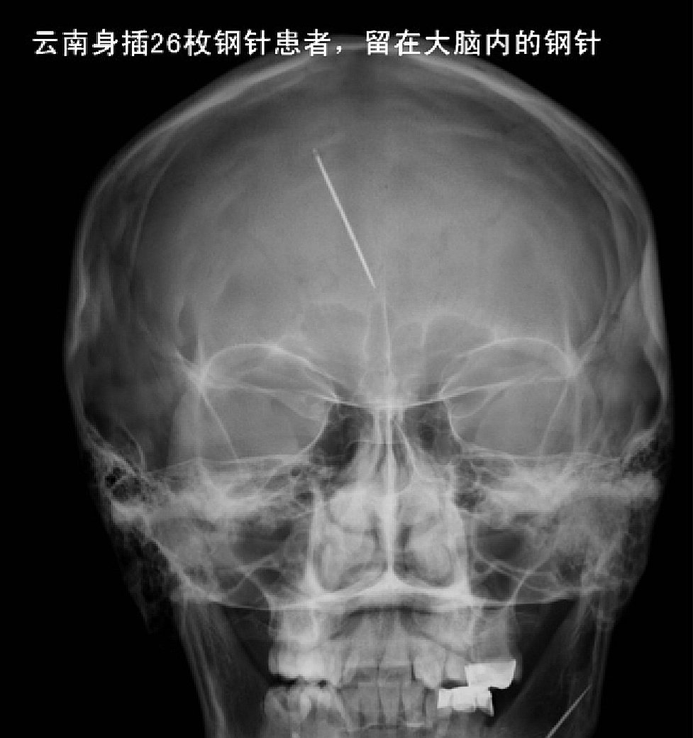 2004年，农妇体内发现藏26根缝衣针，头部钢针直插大脑，凶手成谜