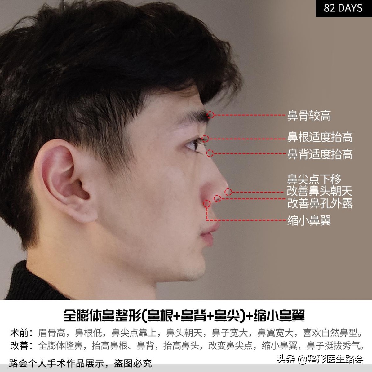 等待2年之久，从海南到北京，鼻整形真实记录，82天后“很惊艳”