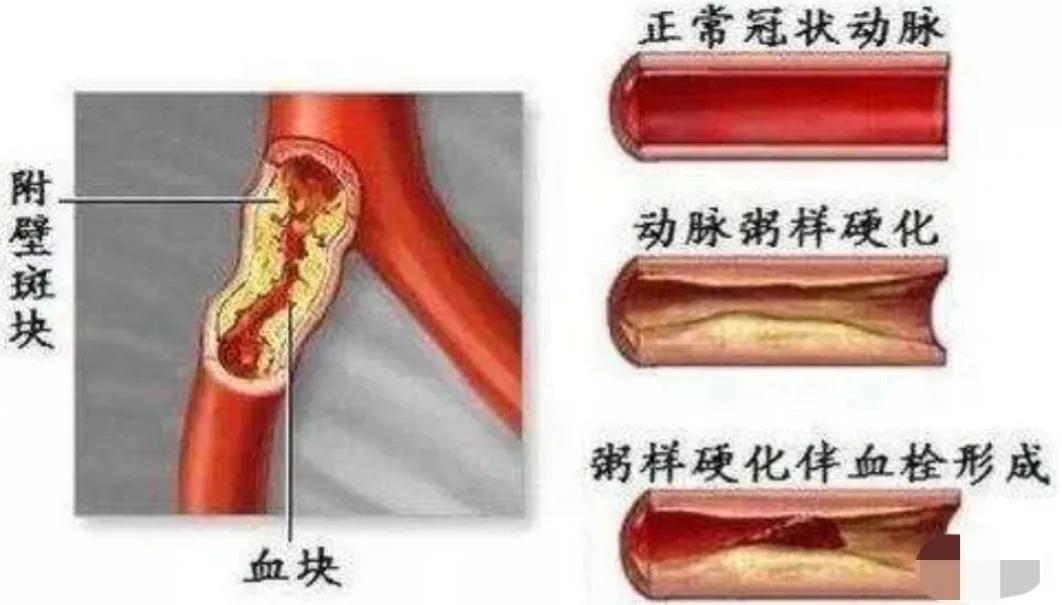 坚持7年，颈动脉斑块“消失”，4种方法“护血管”，真的可以做到