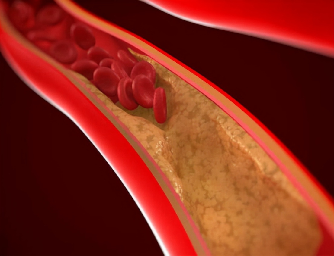 3种中成药，降血脂、抗动脉粥样硬化，有效保护心脑血管