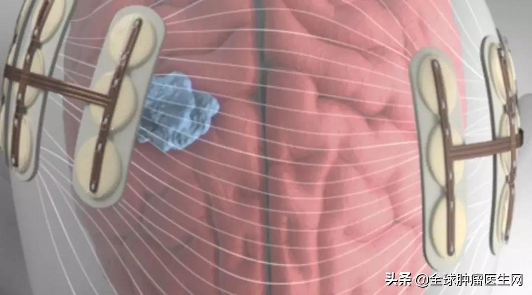 三大强效抗癌技术联手!脑瘤患者生存期或将再翻一倍