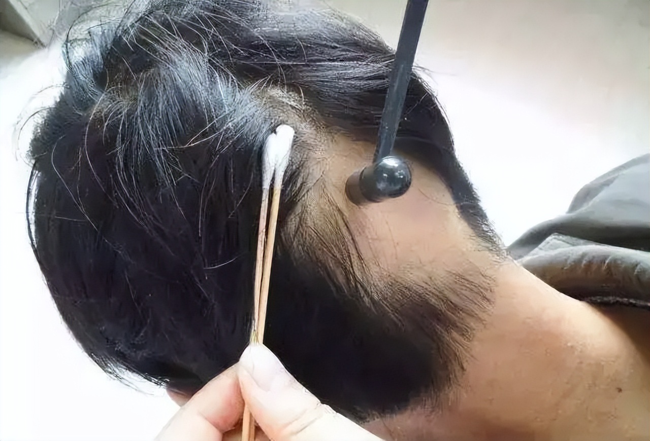 的西药77辨证施治的中药;另一方面,在治疗上采用梅花针叩刺整个头皮