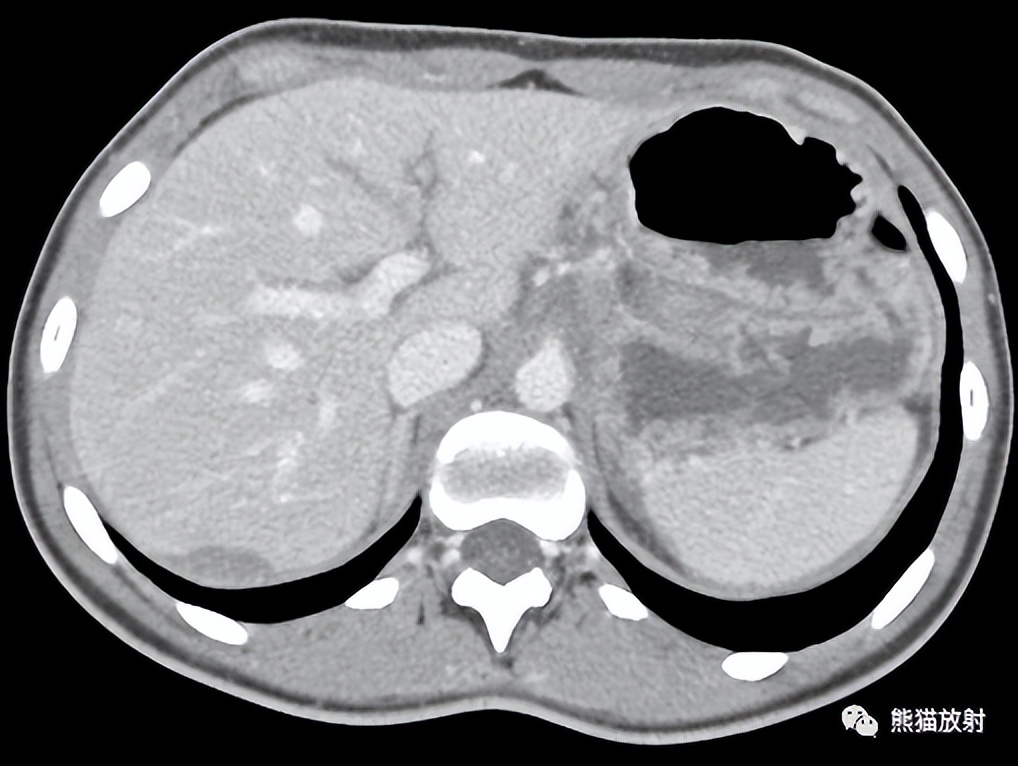 活动性出血(iii级)肝破裂,活动性出血(iv级),腹腔积血肝脏撕裂伤(v级)