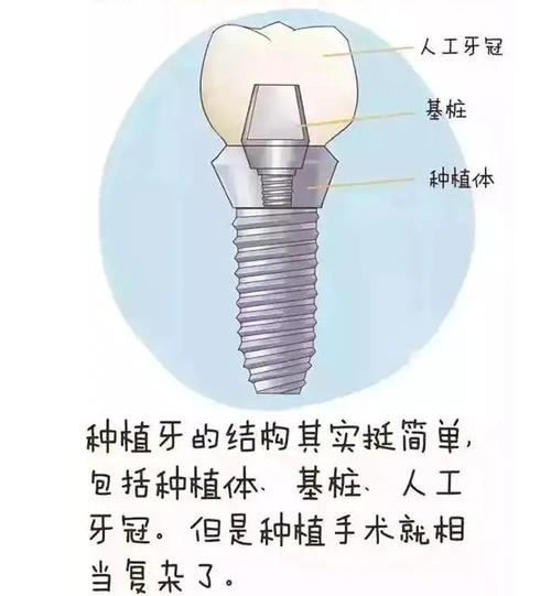 假牙的种类，价格，怎么选，你都知道吗？