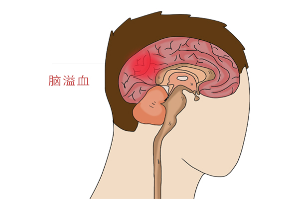脑梗死和脑卒中，是同一种病吗？预防脑梗，牢记“3麻2慢1疼痛”