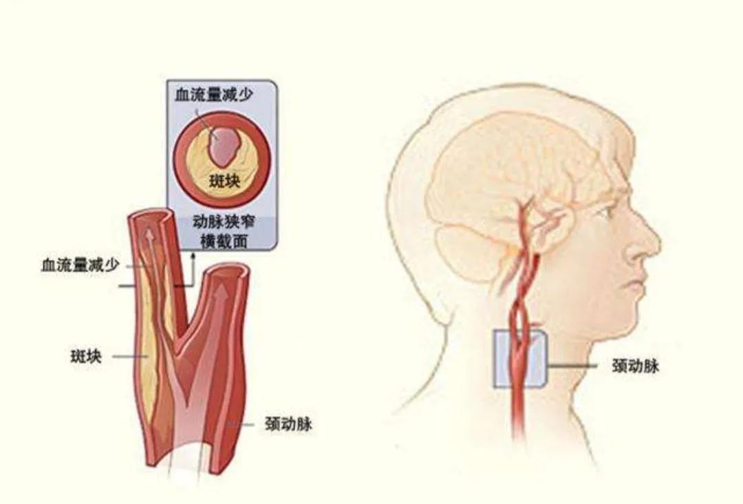 坚持7年有效消除血管斑块的方法