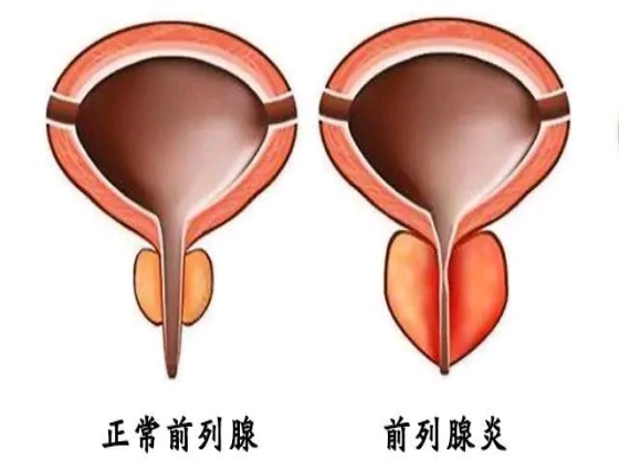 前列腺增生和前列腺炎,一字之差,兩個用藥方案,您用對了嗎?