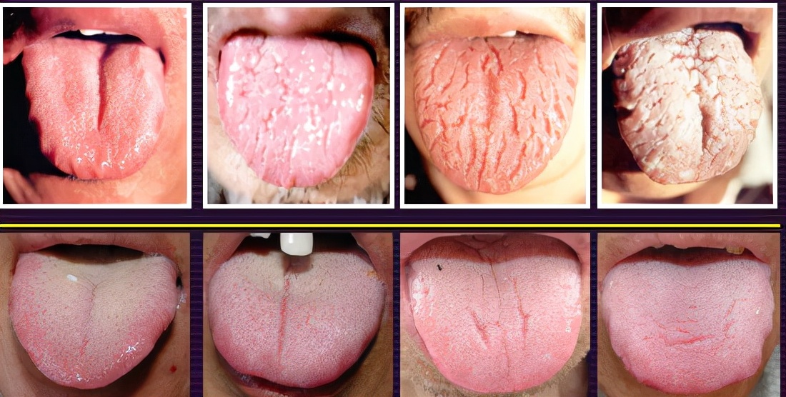临床常见11种舌象分析,看看你是属于哪一种?