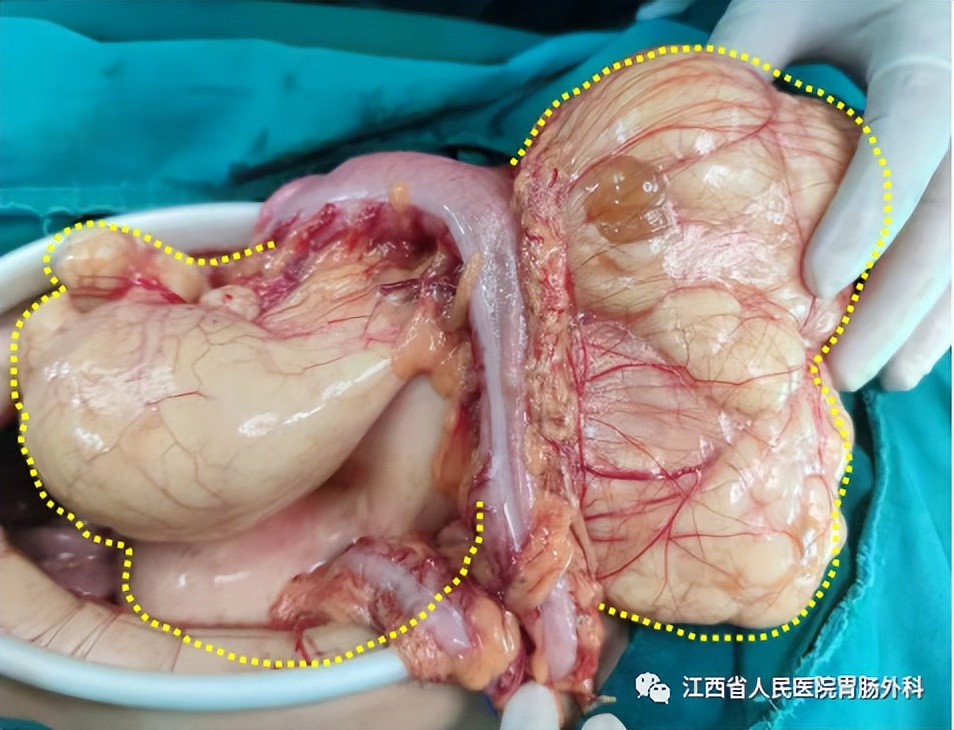花季少女腹藏巨大肿瘤！省人民医院精心“拆弹”解难题