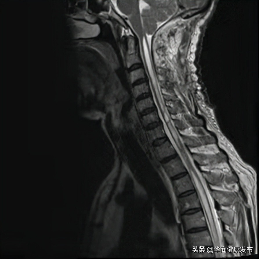 颈部疼痛的原因(颈部疼痛不适长达11年，本以为是颈椎病，没想到竟是先天性疾病……)