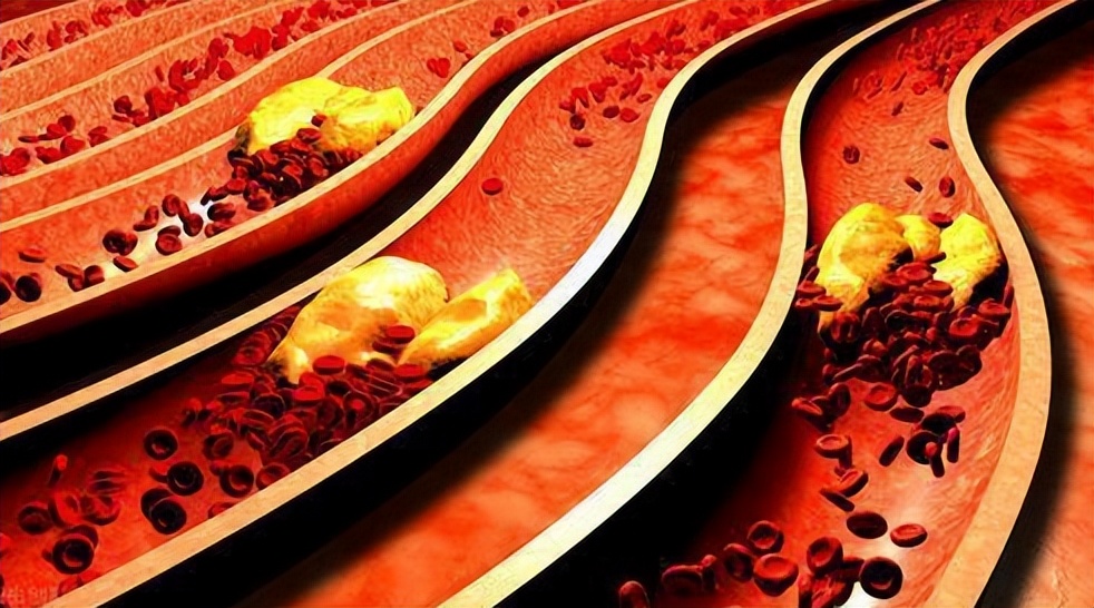 花生，是“养血管”还是“伤血管”？权威结果发布，越早知道越好