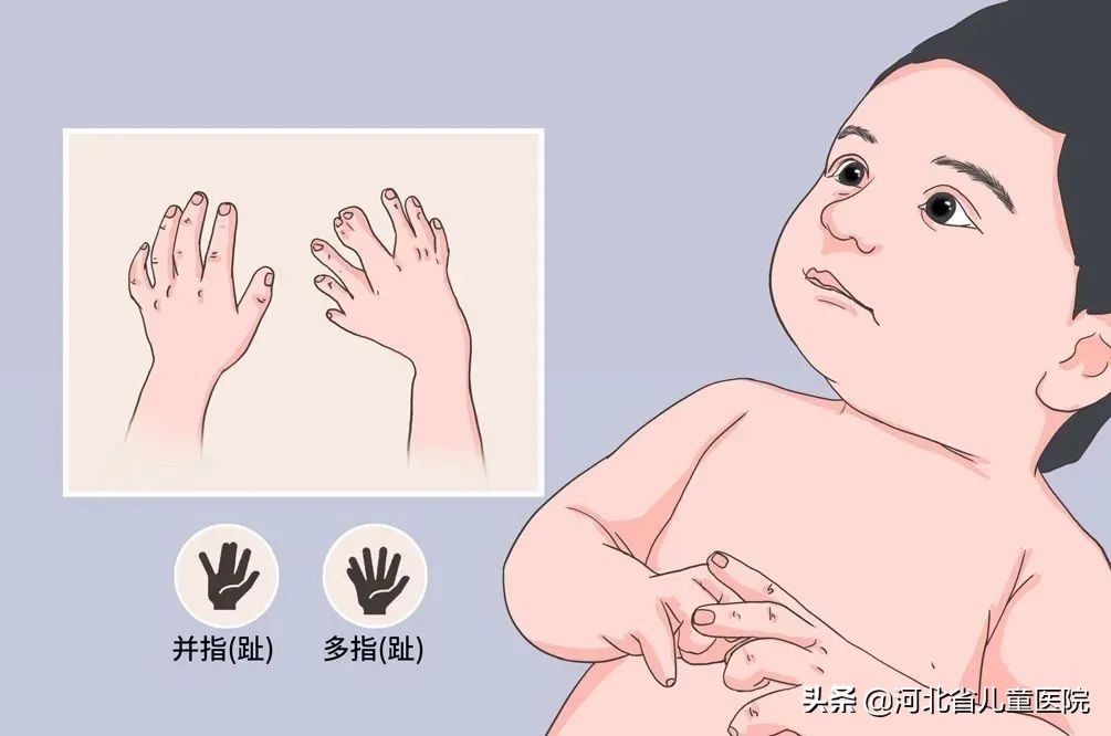 儿童并指畸形的类型及治疗