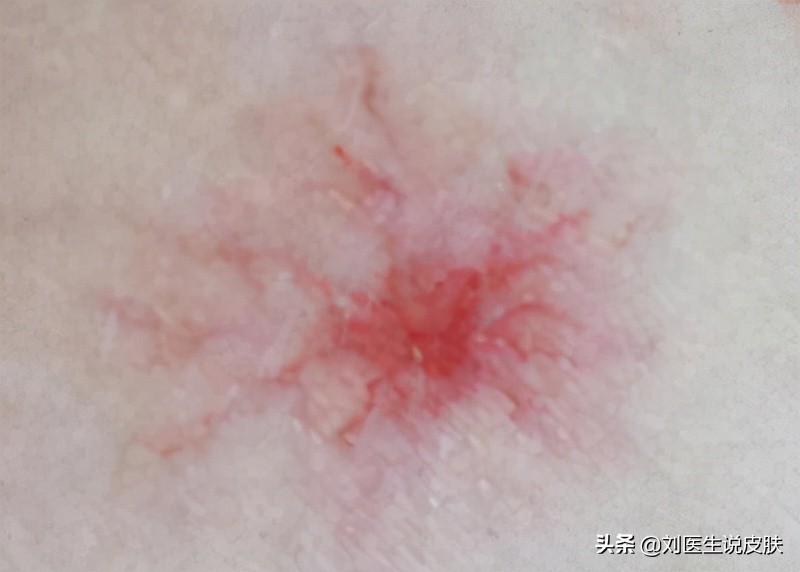 身上长蜘蛛痣，就是肝硬化的征兆？医生：不一定，或会自行消失