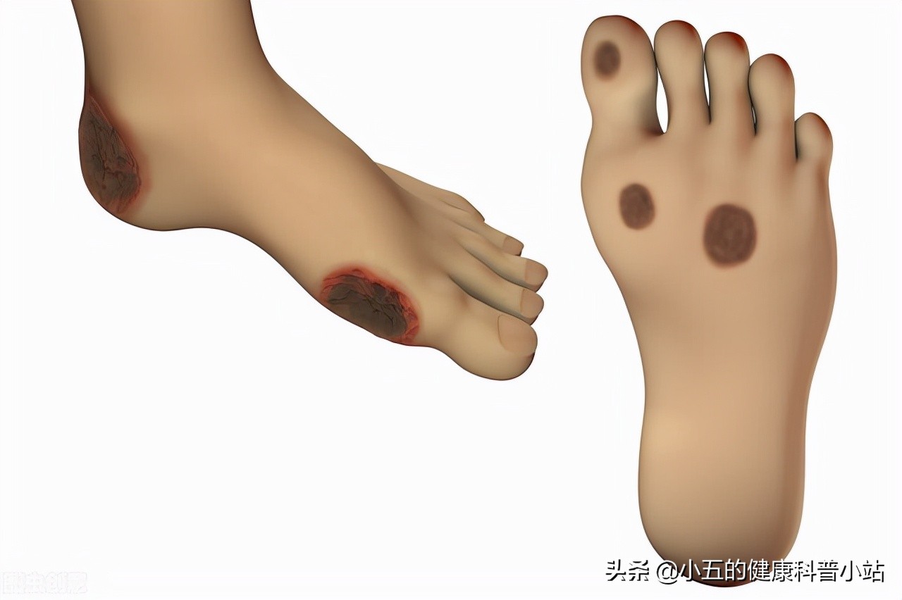 便宜的维生素B12是营养神经、改善贫血的良药，服用时应注意5点