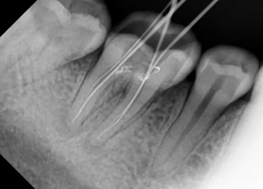 为什么现在看牙病都必须拍片？又是医院新套路？