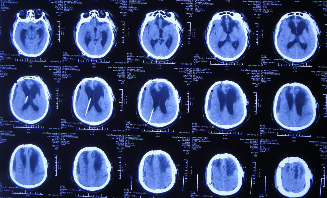 脑外伤颅骨修补术和分流术后脑积水加重致昏迷