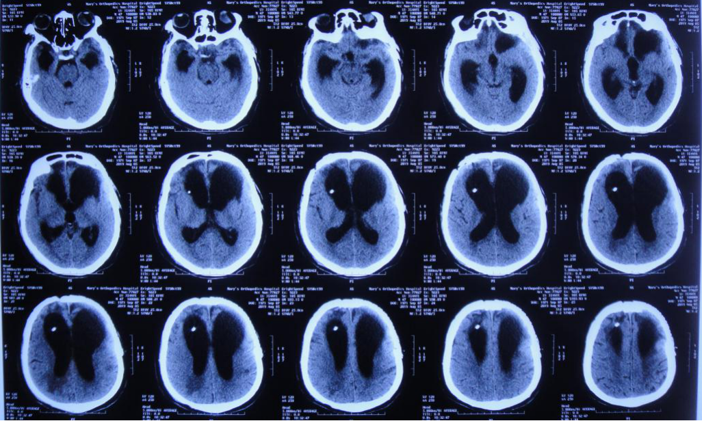 脑外伤颅骨修补术和分流术后脑积水加重致昏迷