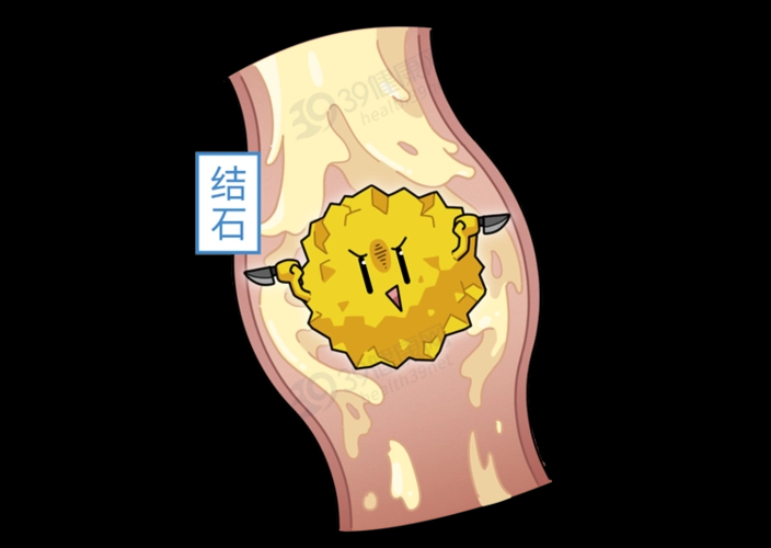 胆囊并非可有可无，切除后对身体有哪些影响？医生一文解释清楚