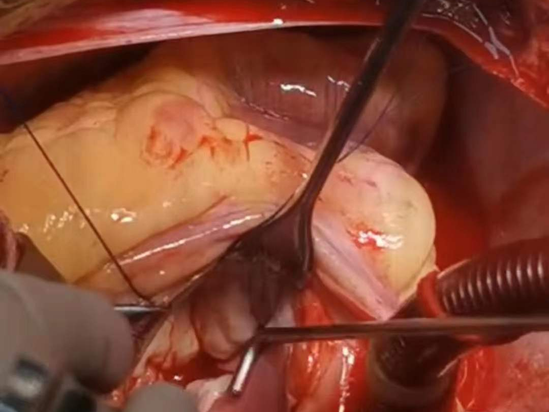 江西省心血管病医院一病区常规开展Barlow病高难度手术
