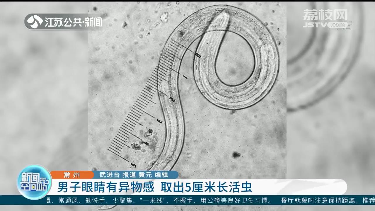 常州一男子眼睛有异物感 医生手术取出5厘米长活虫