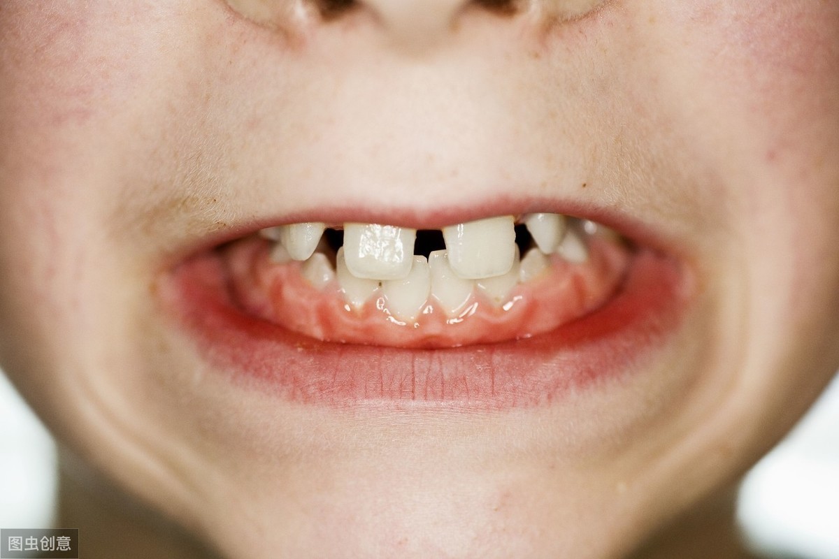 儿童牙齿矫正一般多少钱孩子牙齿的矫正有3个黄金期