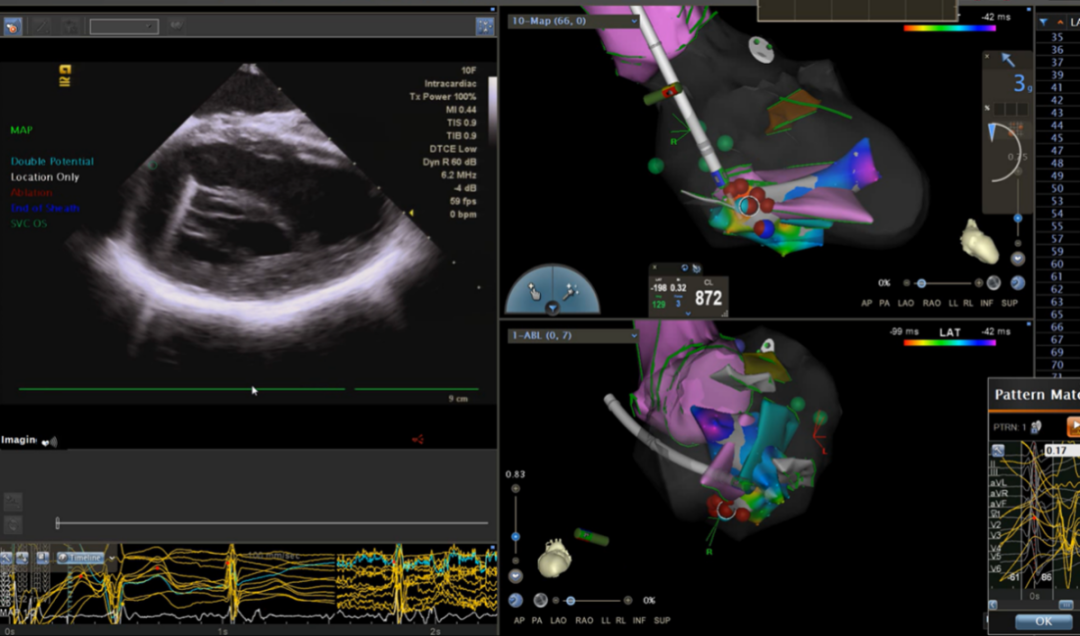仁医病例丨方哲参与指导多例疑难性室早射频消融治疗