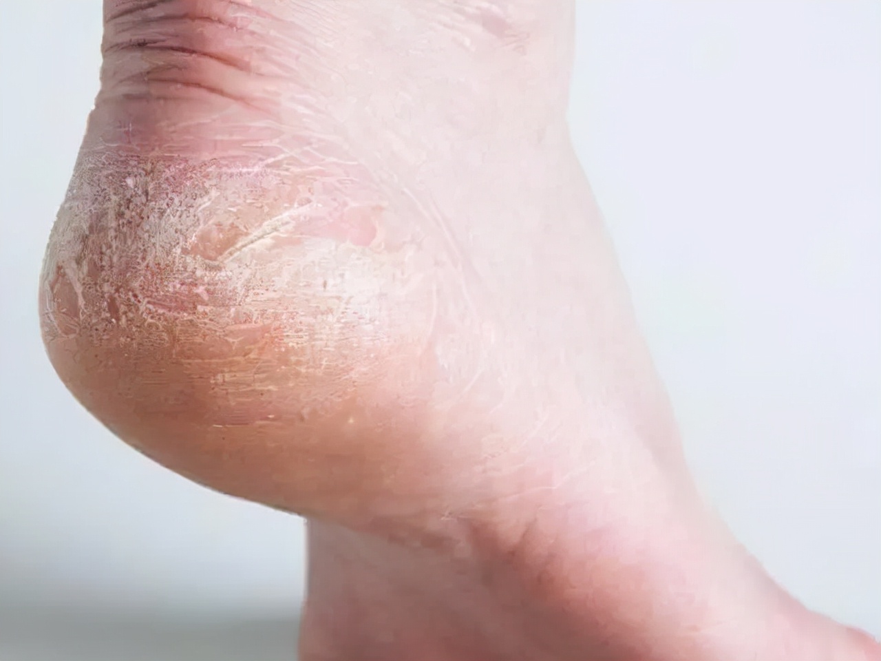 脚后跟痛？不要再忍了！医生提醒：可能与这3种疾病有关