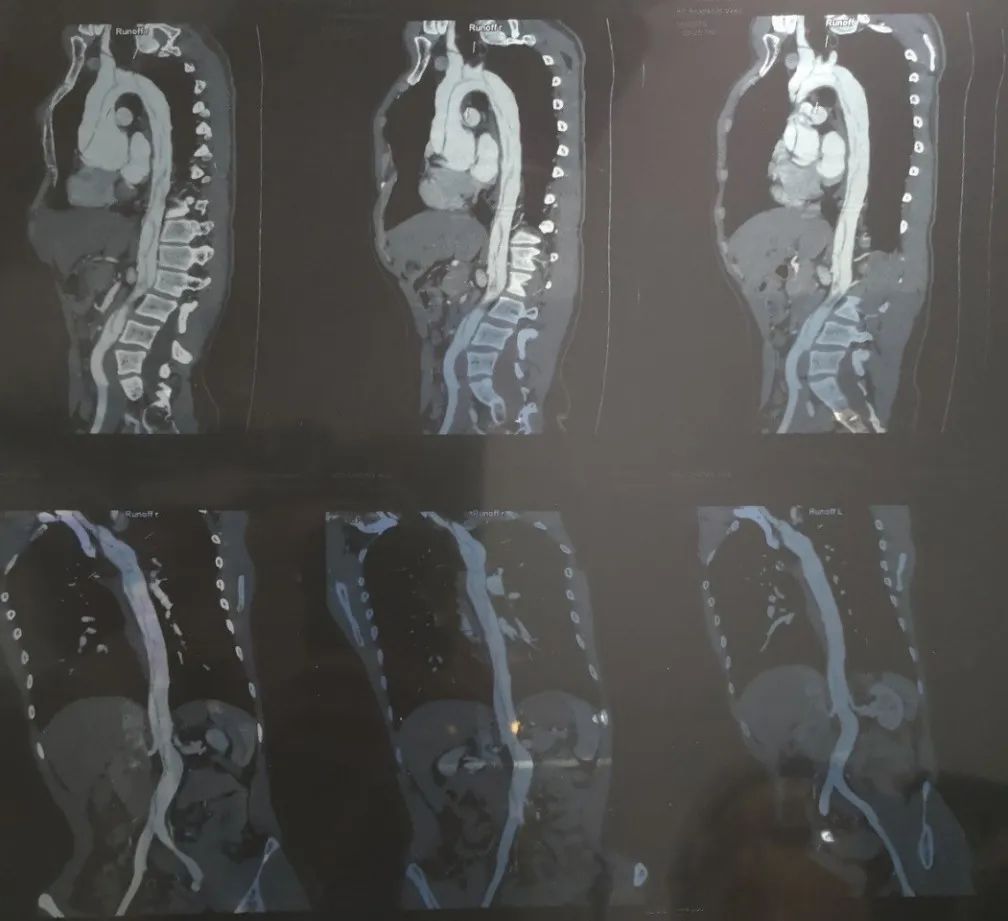 1米9的我常被当作山东大汉的代表，但我是得病了才又瘦又高的