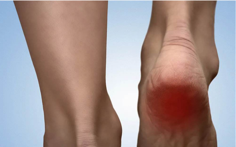 脚后跟痛？不要再忍了！医生提醒：可能与这3种疾病有关