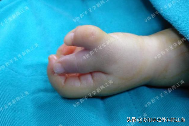 做六指手术需要多少钱六指并不是简单