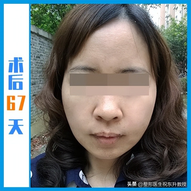 48岁把拉皮手做了，术后16天-120天，无P图 不美颜 真实反馈