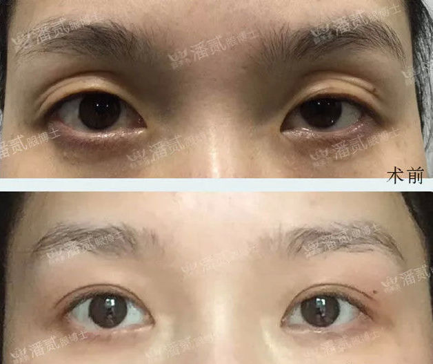 以下眼窝凹陷的5种情况,你是哪一种?分别有什么改善办法?