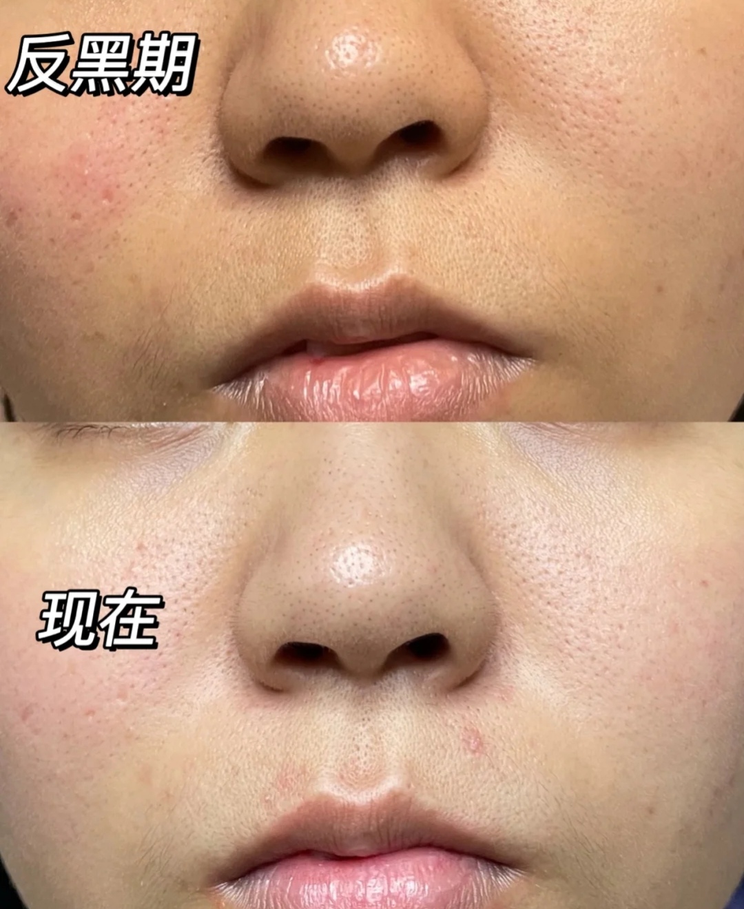 早C晚A这阵风你跟了吗？其一建立耐受，重在防反黑，不可操之过急