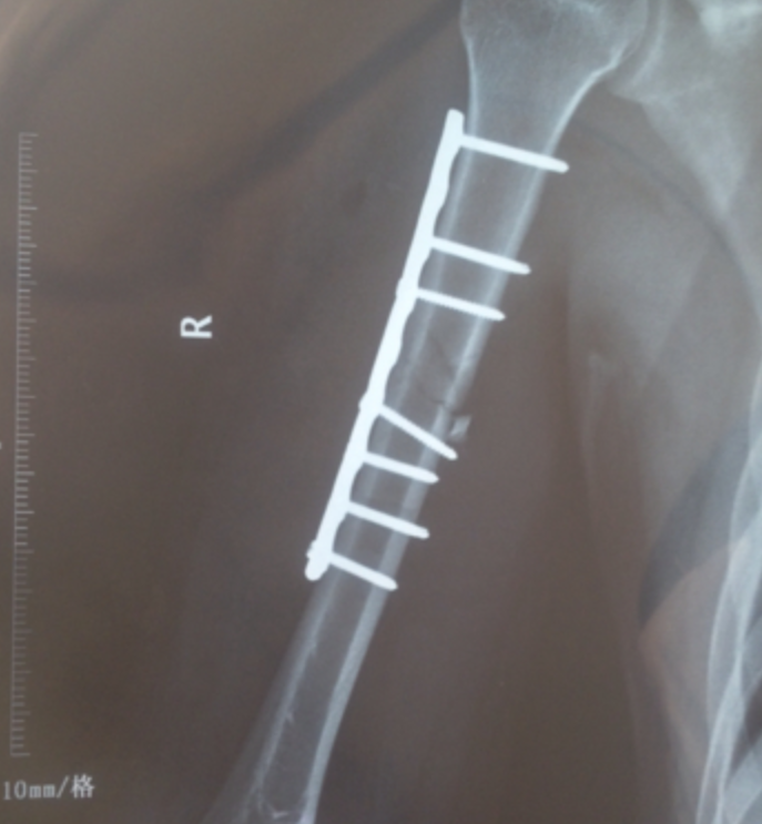 7年了，湖南男孩674分考清华，父亲每天挑200担沙，后来怎样了？