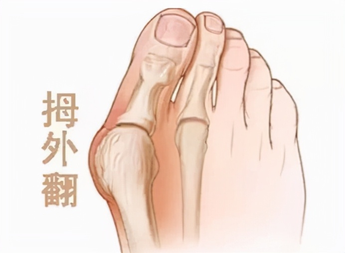 脚底板爱生茧子,走路疼痛是怎么回事?或是这些部位出现了问题