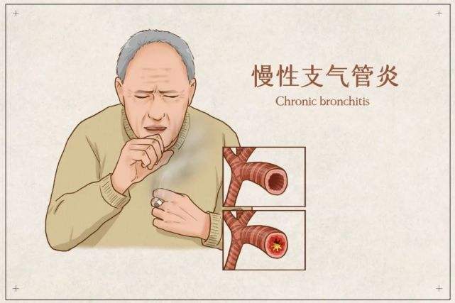 慢性支氣管炎怎麼確診