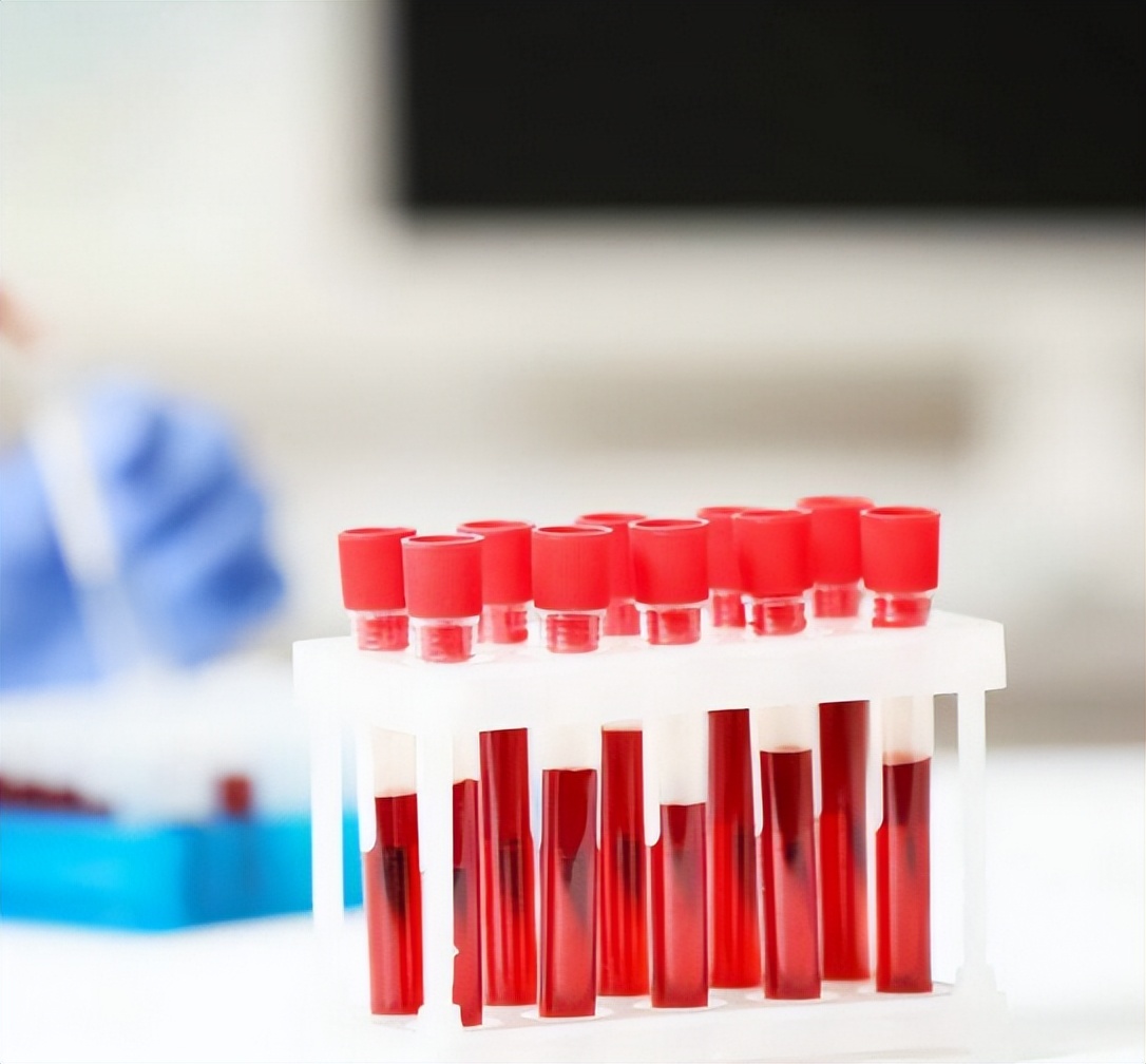 尿酸“超标”，身体会出现4个“信号”，占一个，也要开始控制