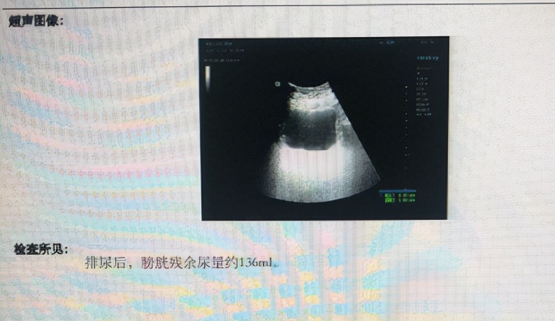 憋不出尿，是肾出故障，还是膀胱坏了？医生带你涨知识