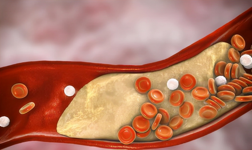 血管专家提醒：血脂超标，这几种食物尽量要忌口，应牢记