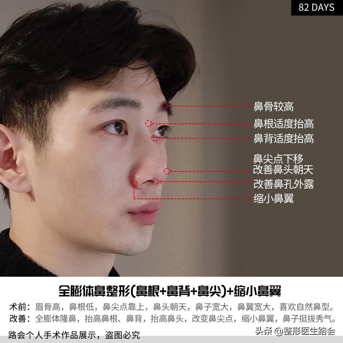 等待2年之久，从海南到北京，鼻整形真实记录，82天后“很惊艳”