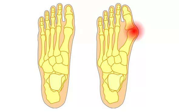 脚底疼痛部位图解(一份“双脚疼痛图解”，详解不同位置脚疼原因)