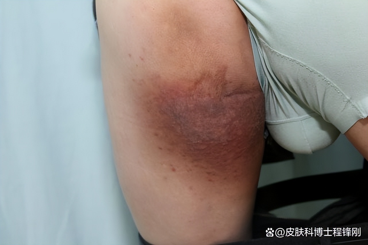 大腿内侧一小块“红斑”，被误诊10年，斑块越治越大
