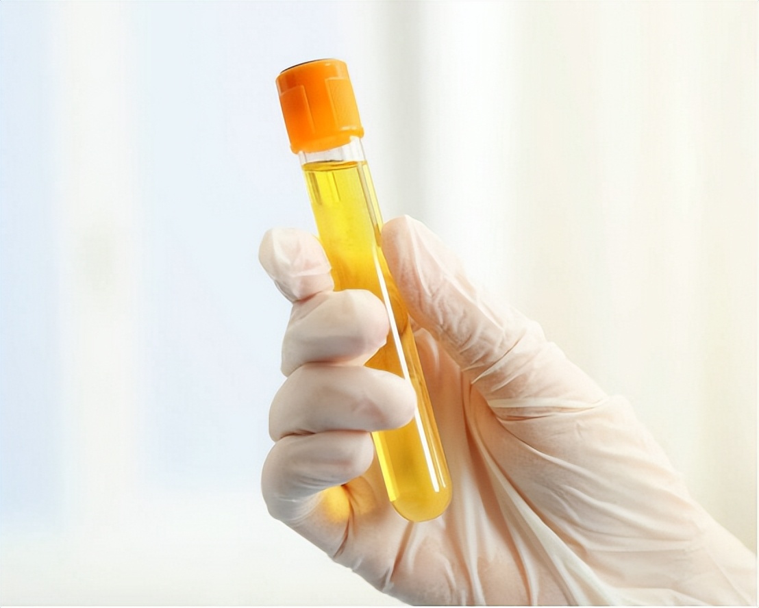 尿酸“超标”，身体会出现4个“信号”，占一个，也要开始控制